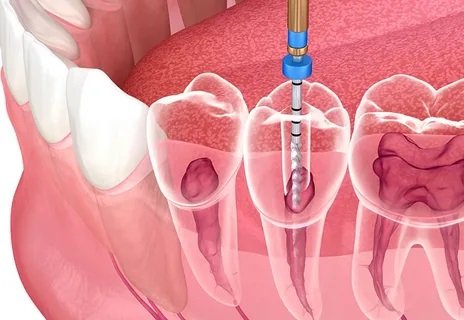 Is Root Canal Treatment in Islamabad Suitable for Children?